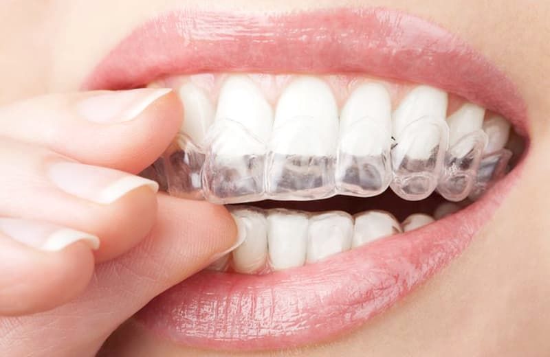 Чому елайнери Invisalign популярні