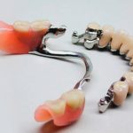бюгельні протези Crystal Dent - стоматологія у Києві