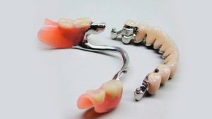 бюгельні протези Crystal Dent - стоматологія у Києві